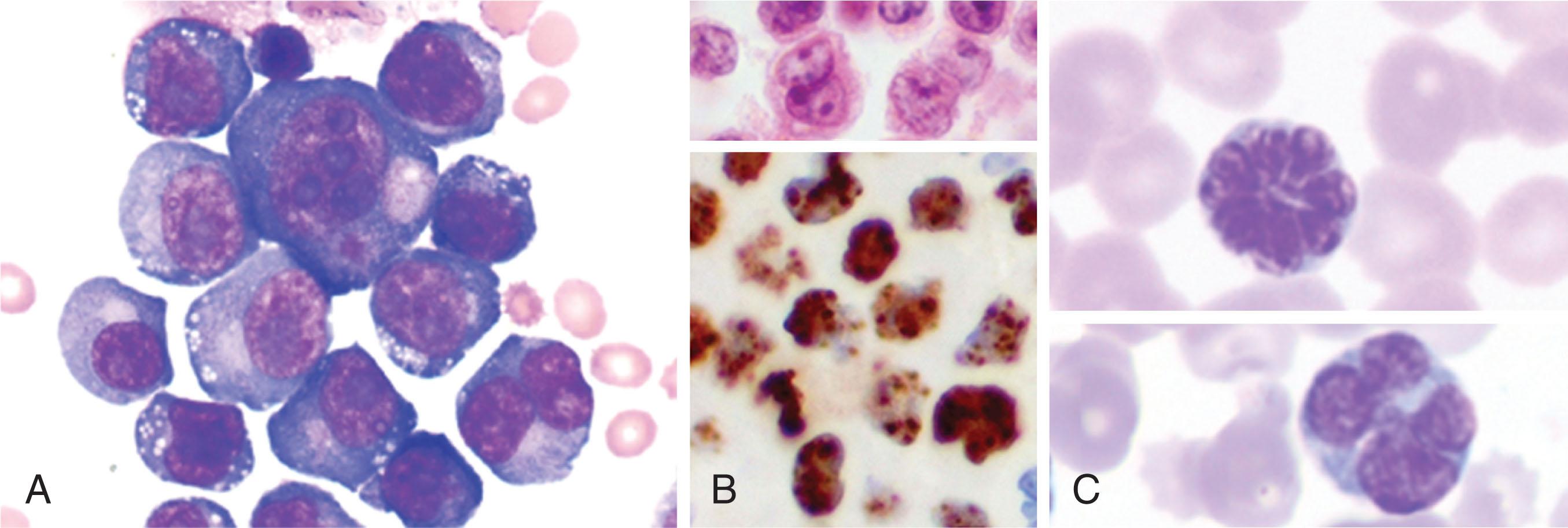 Figure 87.3, EXAMPLES OF KAPOSI SARCOMA–ASSOCIATED HERPESVIRUS AND HUMAN T-LYMPHOTROPIC VIRUS-1 (HTLV-1)–ASSOCIATED LYMPHOPROLIFERATIVE DISEASE.