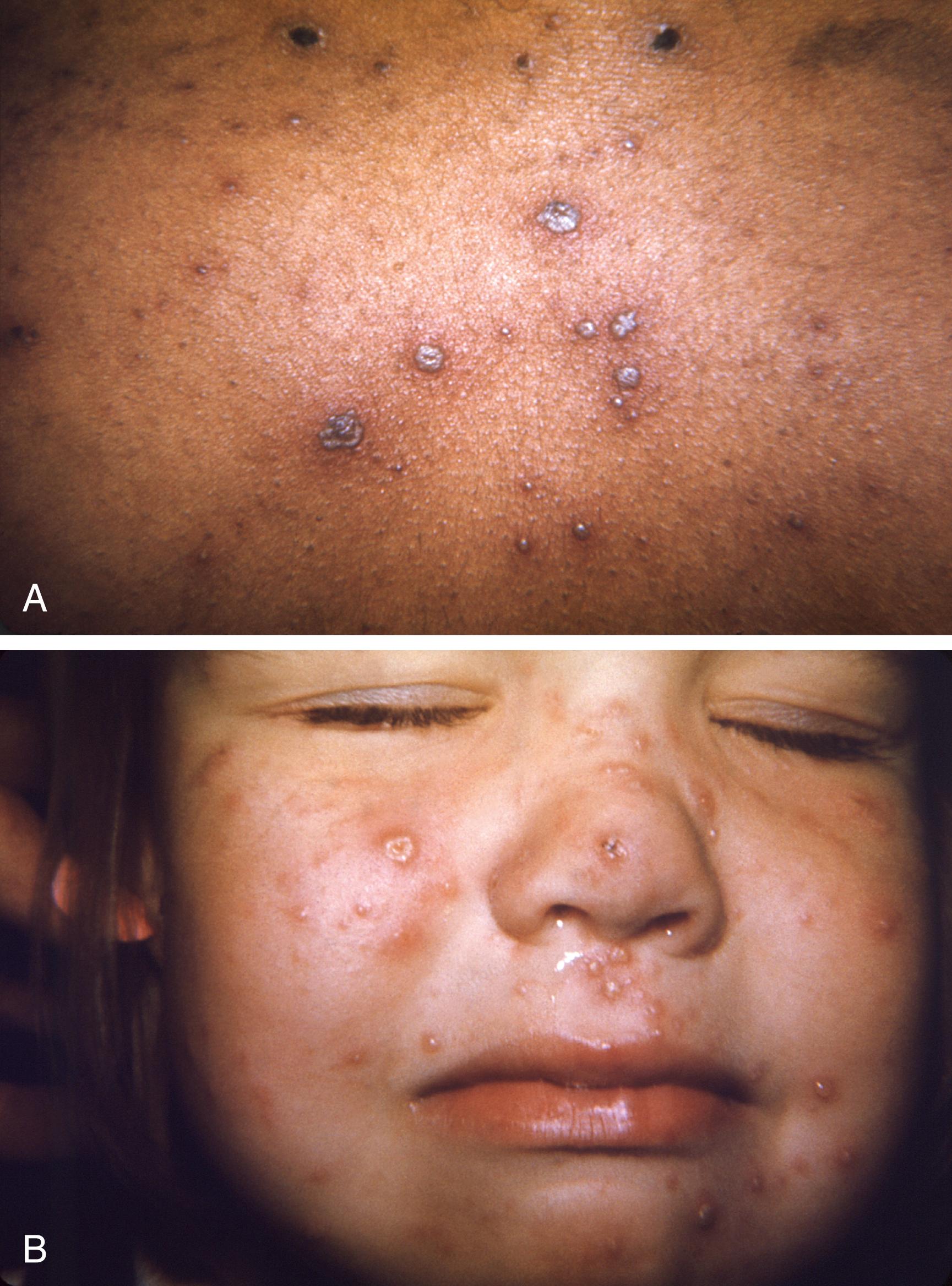 Fig. 119.6, (A and B) Varicella infection demonstrating the typical rash with lesions in different stages of healing.