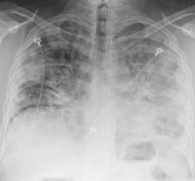 Fig. 13.9, Influenza A pneumonia. Chest radiograph shows diffuse left greater than right consolidation. Influenza was the only virus detected at bronchoscopy.