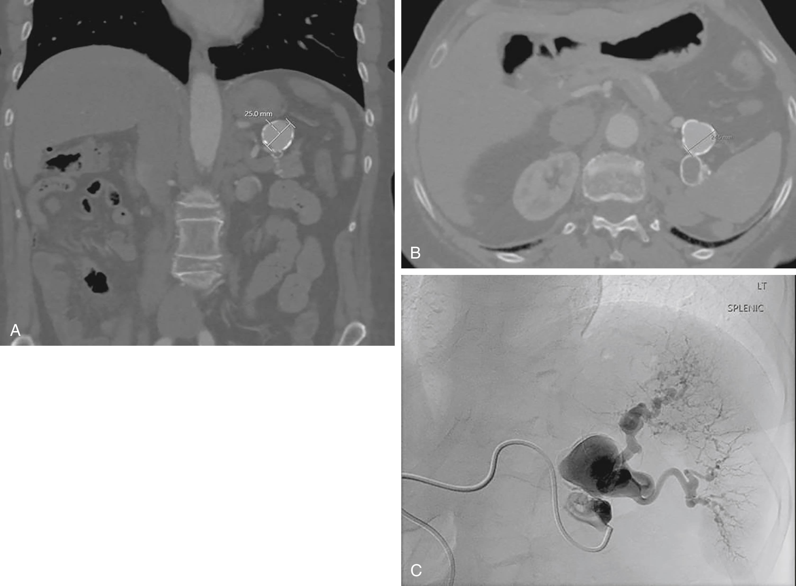 Figure 87.1, A 2.5-cm multilobed splenic artery aneurysm is visualized by CT ( A,B ) and angiogram ( C ). A calcified shell covers the aneurysm sac, with flow maintained to the end organ.