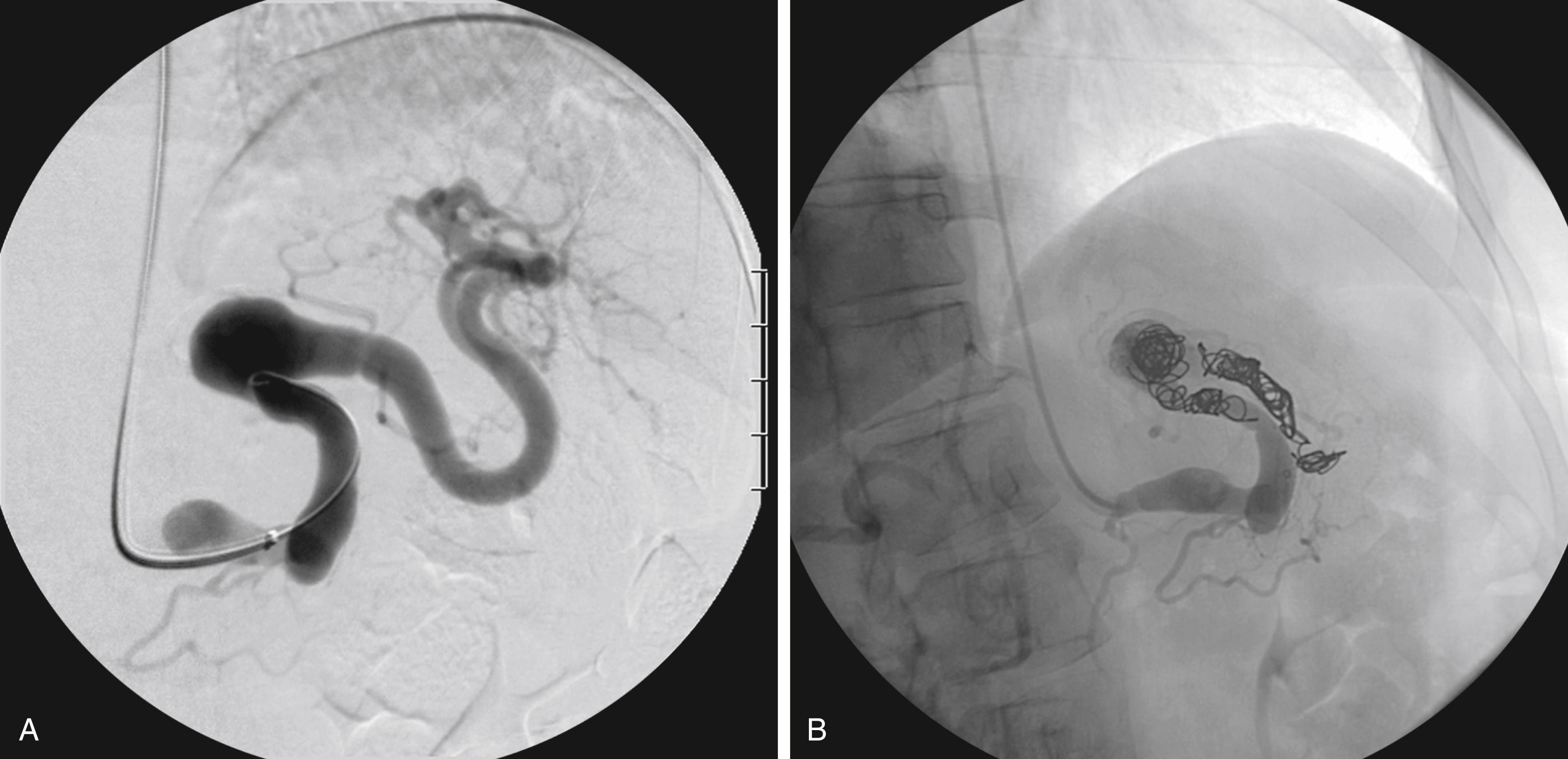 Figure 87.2, ( A ) Angiogram of a 2-cm splenic artery aneurysm prior to intervention. ( B ) Post-intervention angiogram. Aneurysm ablated with nitinol coils. Occlusion of both inflow and outflow to the sac is achieved.