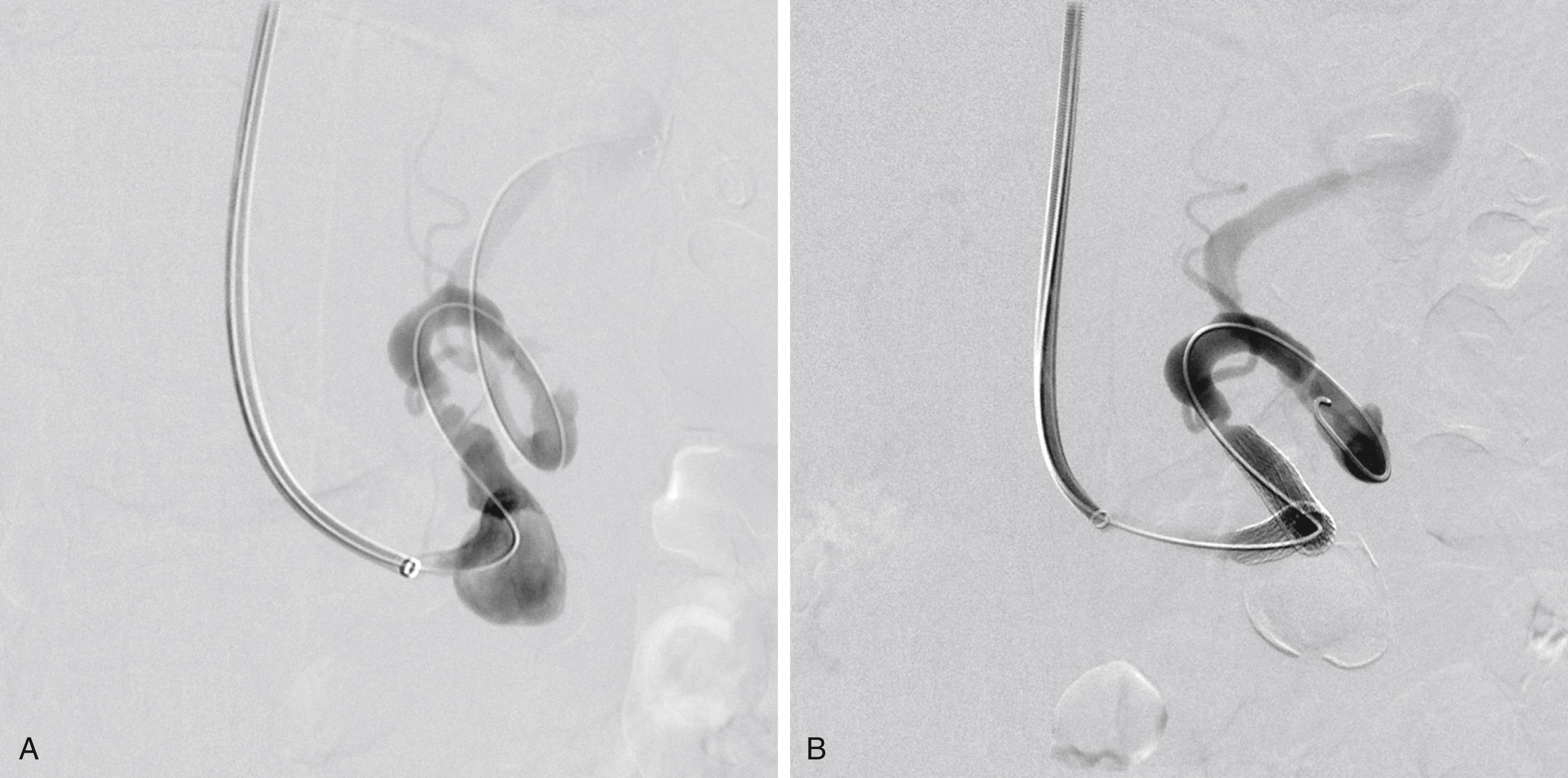 Figure 87.3, ( A ) Angiogram of a 2-cm splenic artery aneurysm prior to intervention. ( B ) Post-intervention angiogram. Aneurysm excluded with covered stent. Post-deployment imaging demonstrates intact flow to end organ.