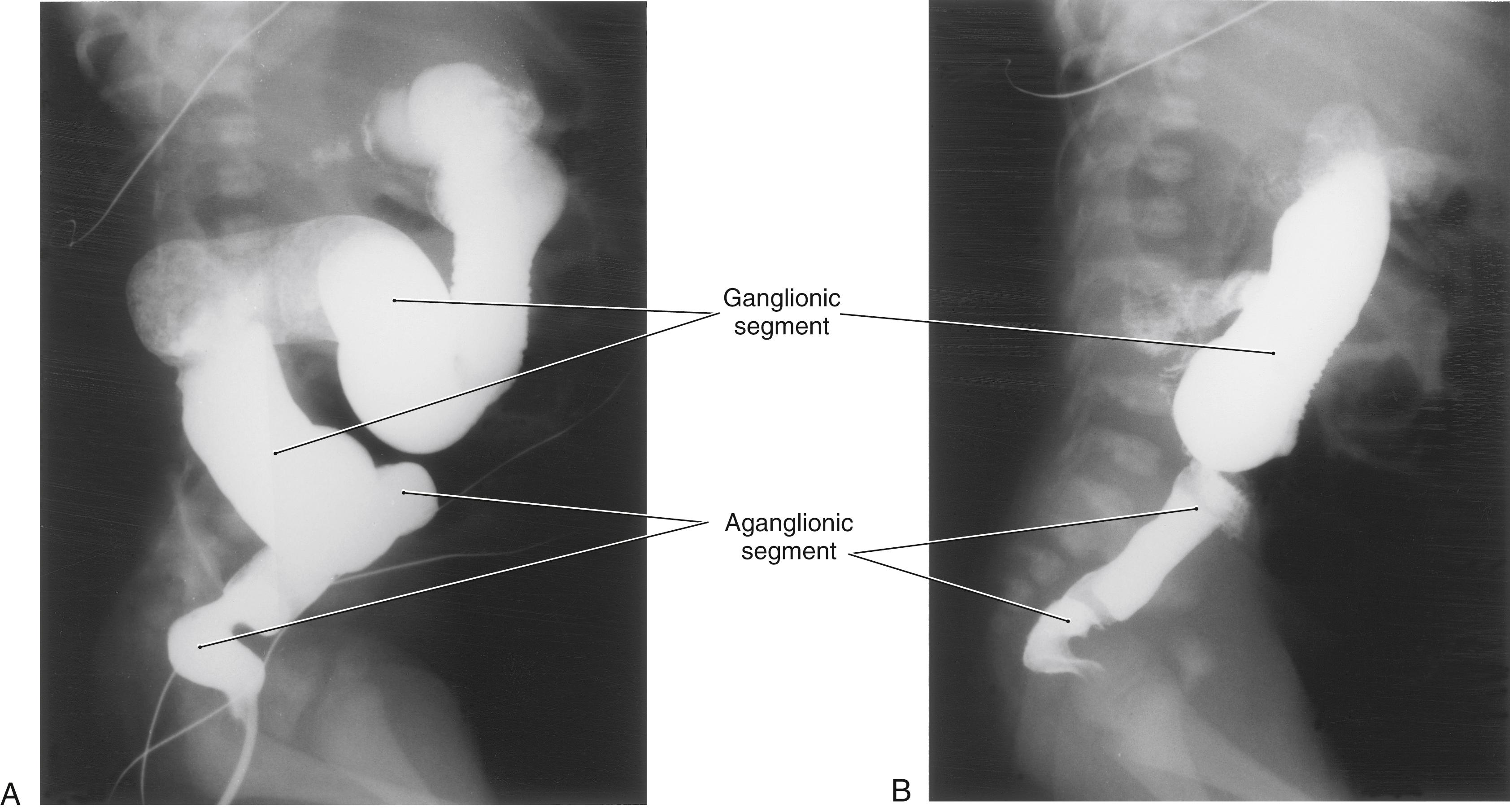 Fig. 29.2, Congenital megacolon in a neonate before ( A ) and after ( B ) evacuation. The affected portion of the large bowel is lacking ganglion cells and is in a chronically constricted state; the dilated portion of the bowel contains ganglion cells ( A and B ).