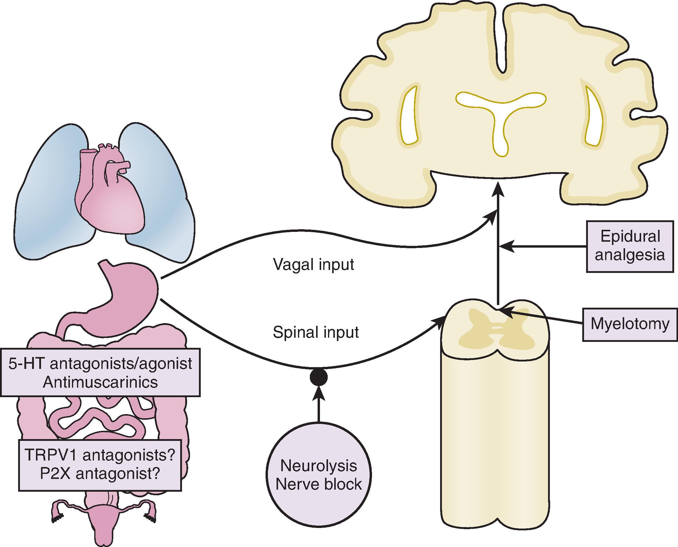 Figure 41.1, Schematic description of visceral innervation and potential targets for analgesic therapy. As indicated by the arrows, most viscera receive a dual sensory innervation with vagal and spinal afferents. Current symptomatic treatment of peripheral targets relies largely on agents interfering with intestinal contractility. However, the capsaicin receptor (TRPV1) and purinergic P2X receptors constitute promising targets for the treatment of visceral pain. Neurolytic block, myelotomy, and epidural analgesia all target spinal afferent pathways involved in relaying visceral pain.