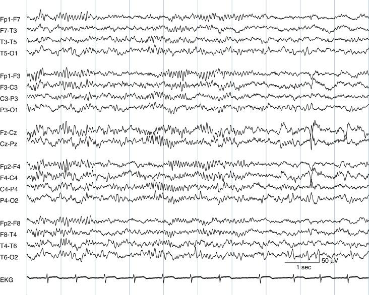 Figure 2-20, In deeper Stage II sleep, spindle activity becomes more prominent. Vertex waves also continue, seen in the last 2 seconds of the page.