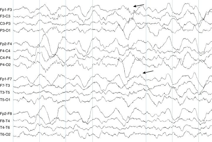 Figure 2-21, A sample of Stage III sleep is shown containing approximately 50% delta activity. Some sleep spindle activity persists (arrows) but is more difficult to appreciate against the backdrop of the slow wave activity.