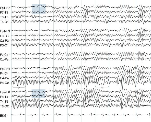 Figure 2-3, The initial transition to drowsiness is marked by a slowing of the posterior rhythm. A frequency of 10 Hz can be counted over the black brace in the first second of this page. The frequency falls to approximately 8 Hz by the seventh second over the blue brace. Artifact from slow roving eye movements can also be seen: note the subtle spreading apart of the waveforms of the two channels that include F7 (top blue rectangle) compared with a relative narrowing together of the two channels that include F8 (bottom blue rectangle). The appearance of this artifact is caused by a slow roving movement of the eyes to the left, a sign of early drowsiness, and is described in more detail in Chapter 6 .