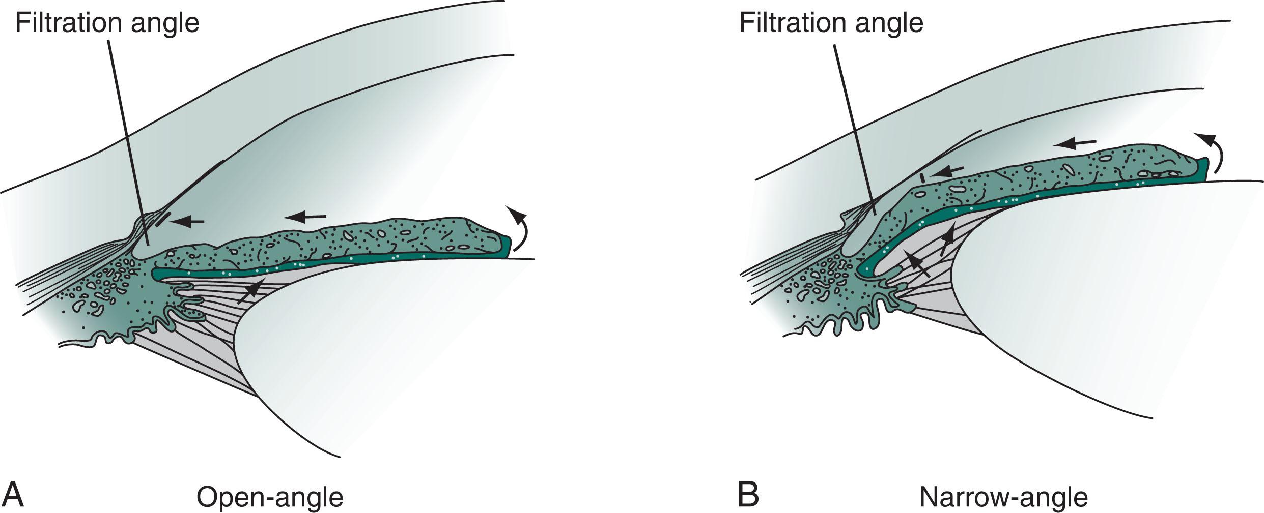 Fig. 12.6, (A) Open-angle glaucoma: drainage of the aqueous humor becomes obstructed, and impaired flow from the eye leads to gradually increased intraocular pressure. (B) Narrow-angle glaucoma: when the iris moves forward, as may occur during pupil dilation, the angle is narrowed or even closed. Obstruction of aqueous humor flow leads to angle-closure glaucoma.