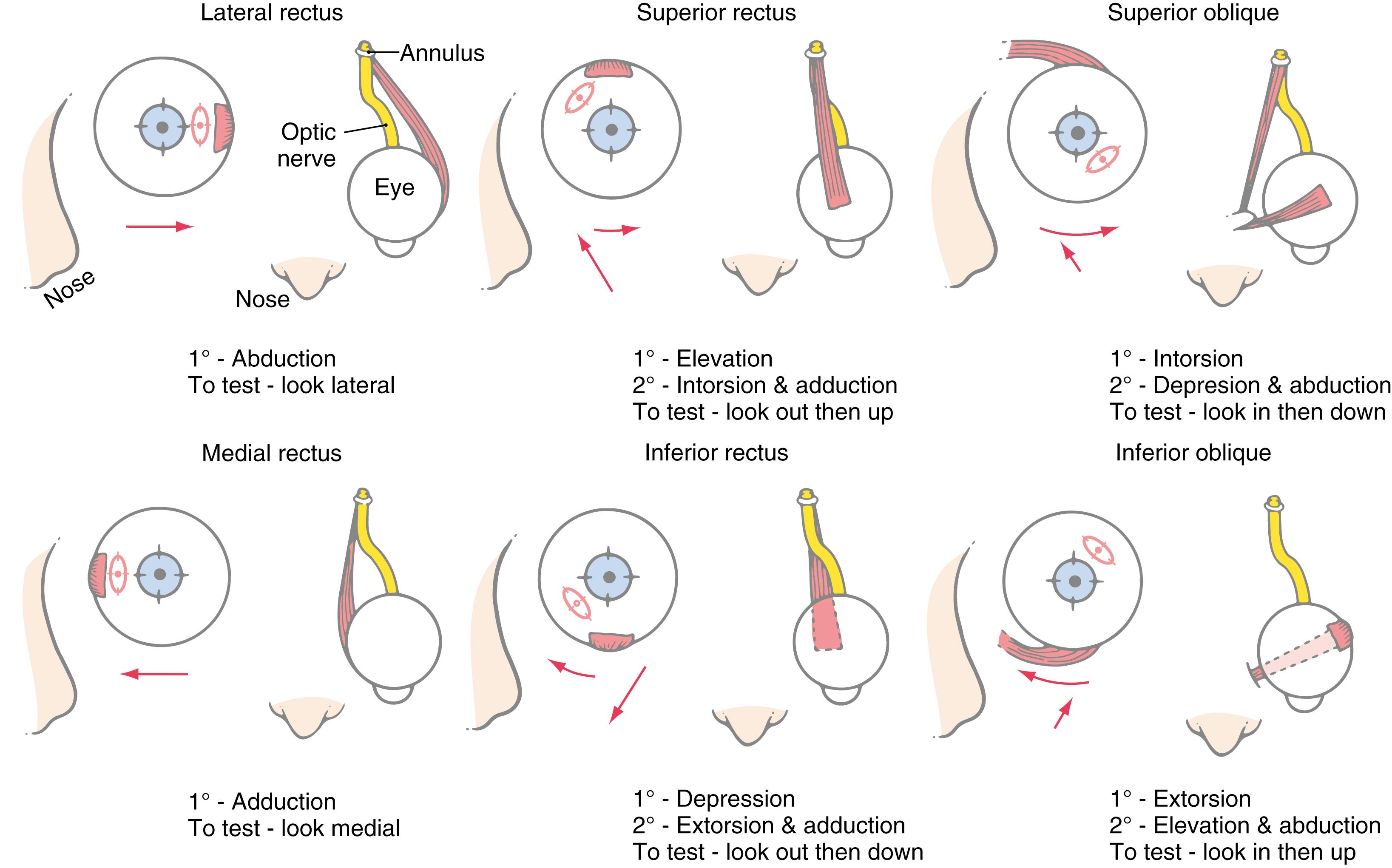 Fig. 28.1, The six extraocular muscles of the left eye in frontal ( left ) and dorsal ( right ) views. The primary ( long arrow ) and secondary ( short arrow ) actions of each muscle and the position of the pupil after the movement ( red oval ) are indicated on the frontal view. These muscles originate at the common tendon (annulus of Zinn), with the exception of the inferior rectus, which originates from the orbit’s nasal wall. Rectus muscles insert in front of the equator of the globe, and the oblique muscles insert behind it. Secondary actions are important for clinical evaluation of muscle function. In these cases, the eye is first rotated to align its axis with that of the muscle; for example, for the inferior oblique, the eye is first adducted and then elevated.