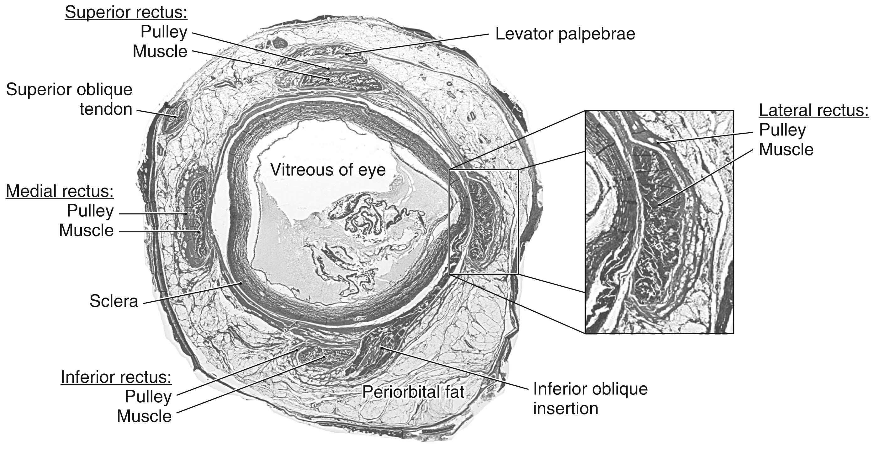 Fig. 28.3, Frontal section through the orbit showing the extraocular muscles and the connective sheaths (pulleys) through which these muscles pass. These pulleys help define the pulling directions of the respective muscle; see also Fig. 28.1 .