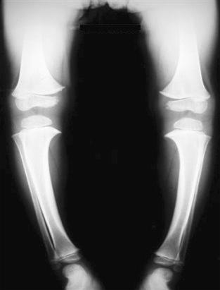 Figure 22.1, Roentgenogram of tibia–-fibula demonstrating classic bowing of the legs in rickets.