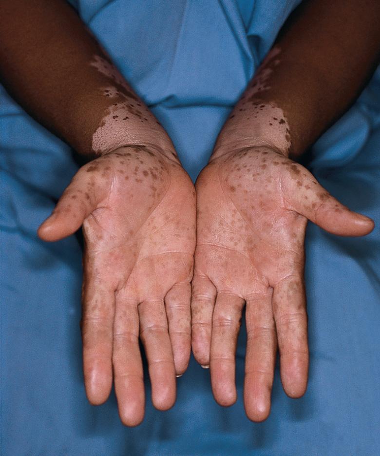 Fig. 66.3, Vitiligo.