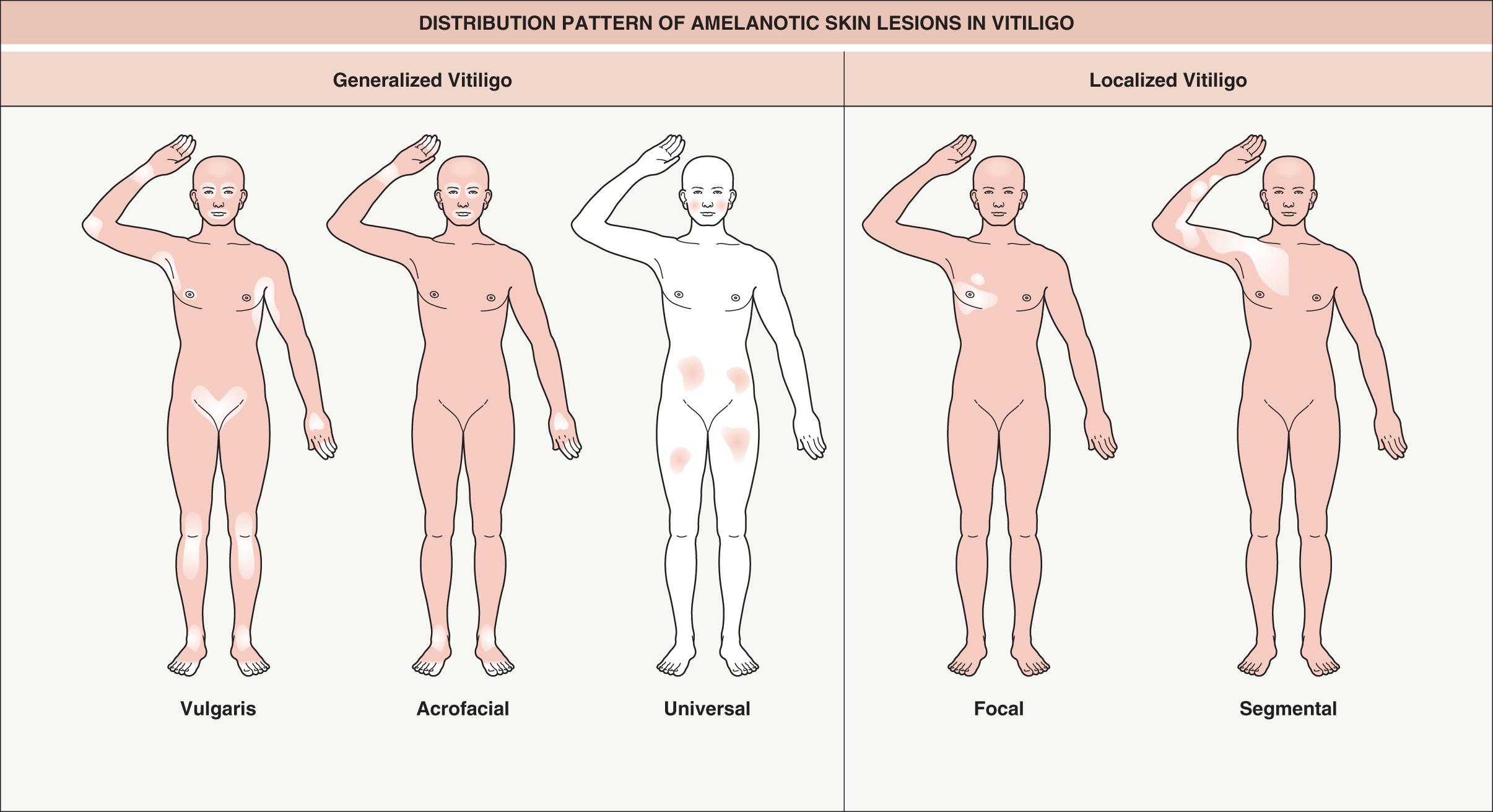 Fig. 66.4, Distribution pattern of amelanotic skin lesions in vitiligo.