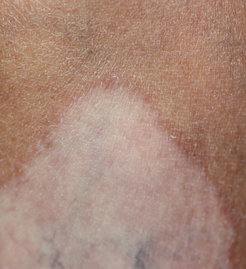 Fig. 66.6, Inflammatory vitiligo.