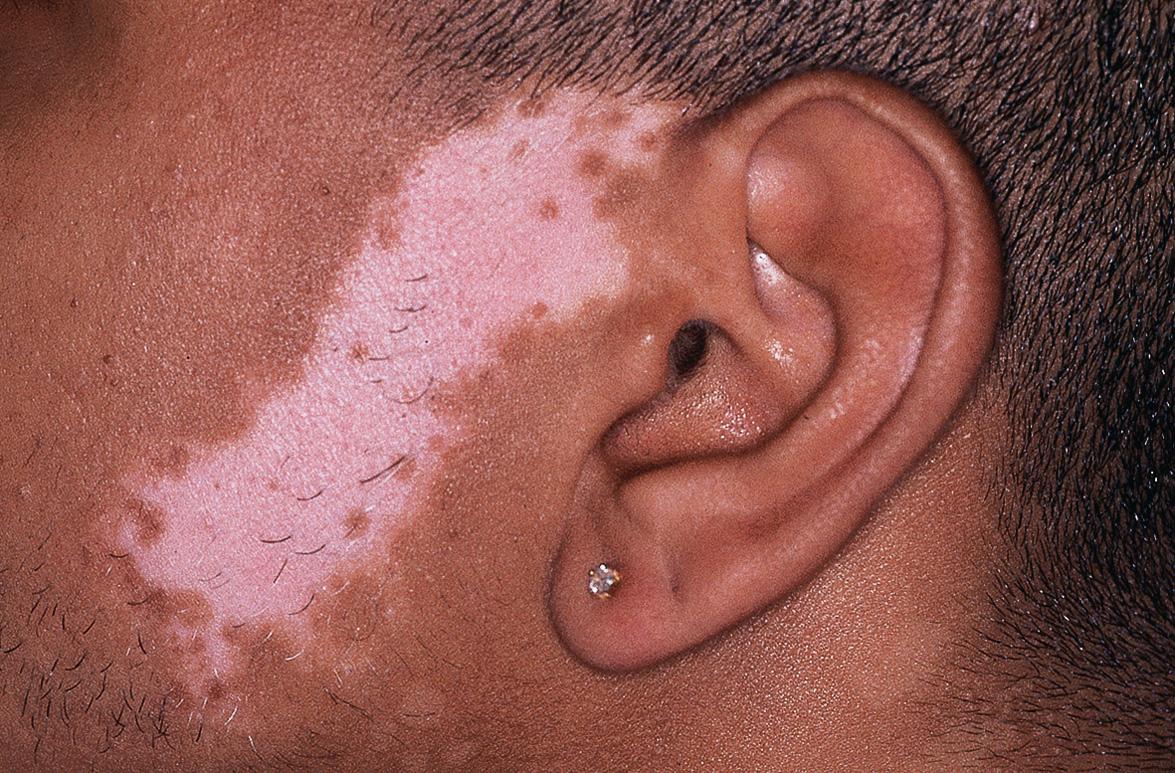 Fig. 66.7, Segmental vitiligo.