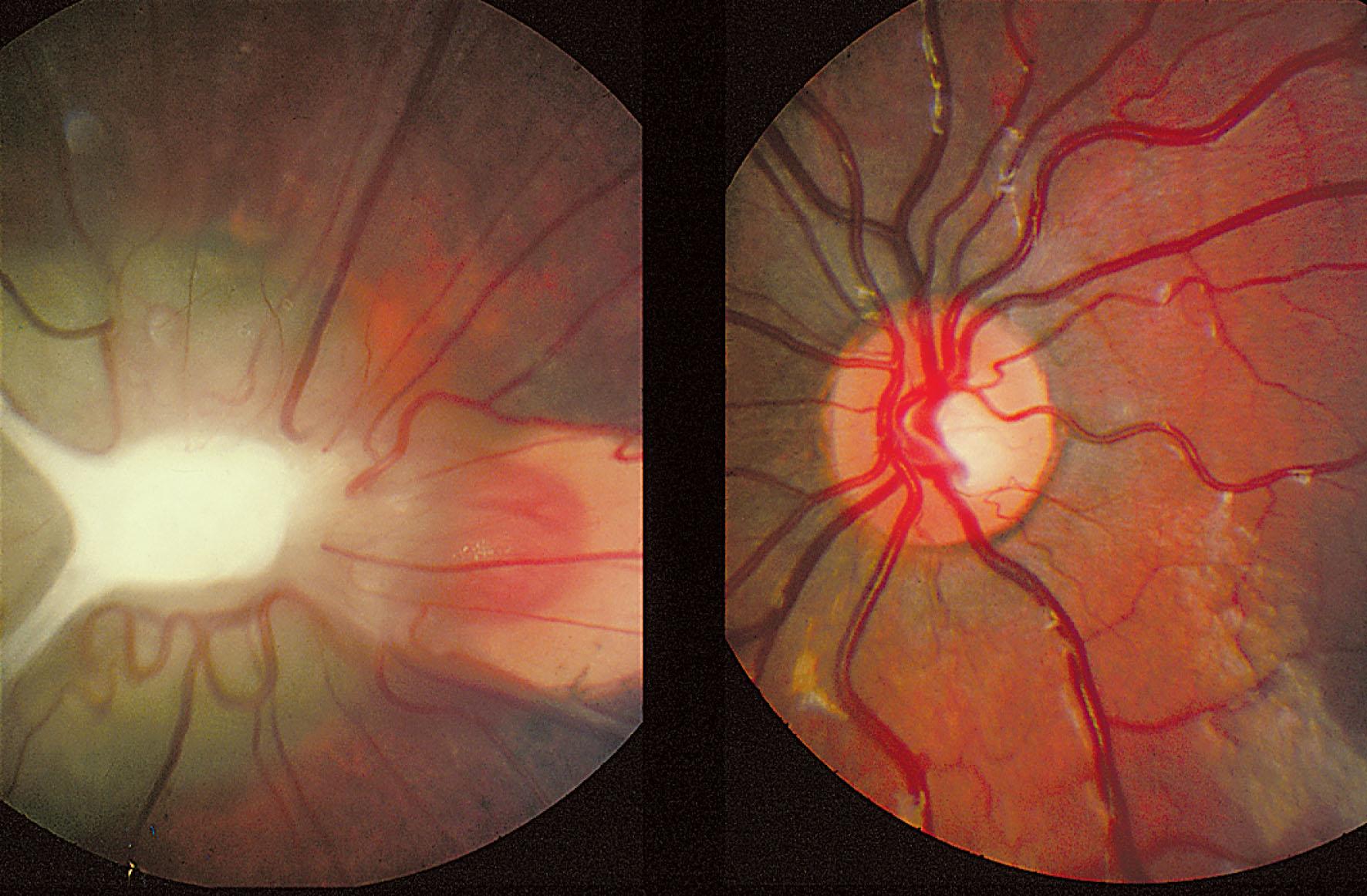 Fig. 41.2, Posterior persistent fetal vasculature. A fold of condensed vitreous running from the optic disc can be seen. The left optic disc is normal.