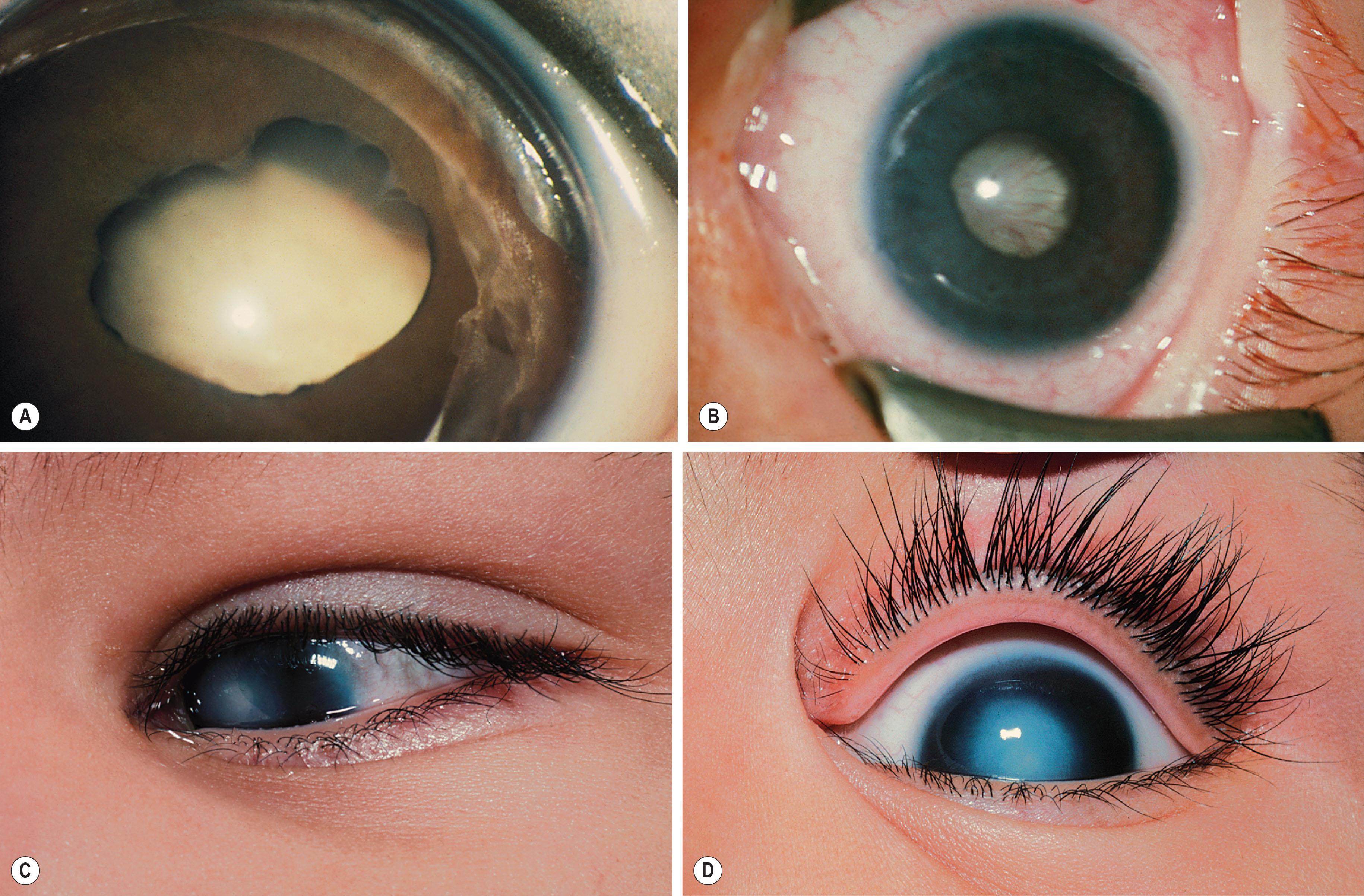 Fig. 41.3, Norrie disease. (A) Posterior synechiae, shallow anterior chamber, and retrolental white mass. (B) Brother of patient in (A) showing vascularized white retrolental mass. (C–D) Flat anterior chambers and lens–cornea adhesions.