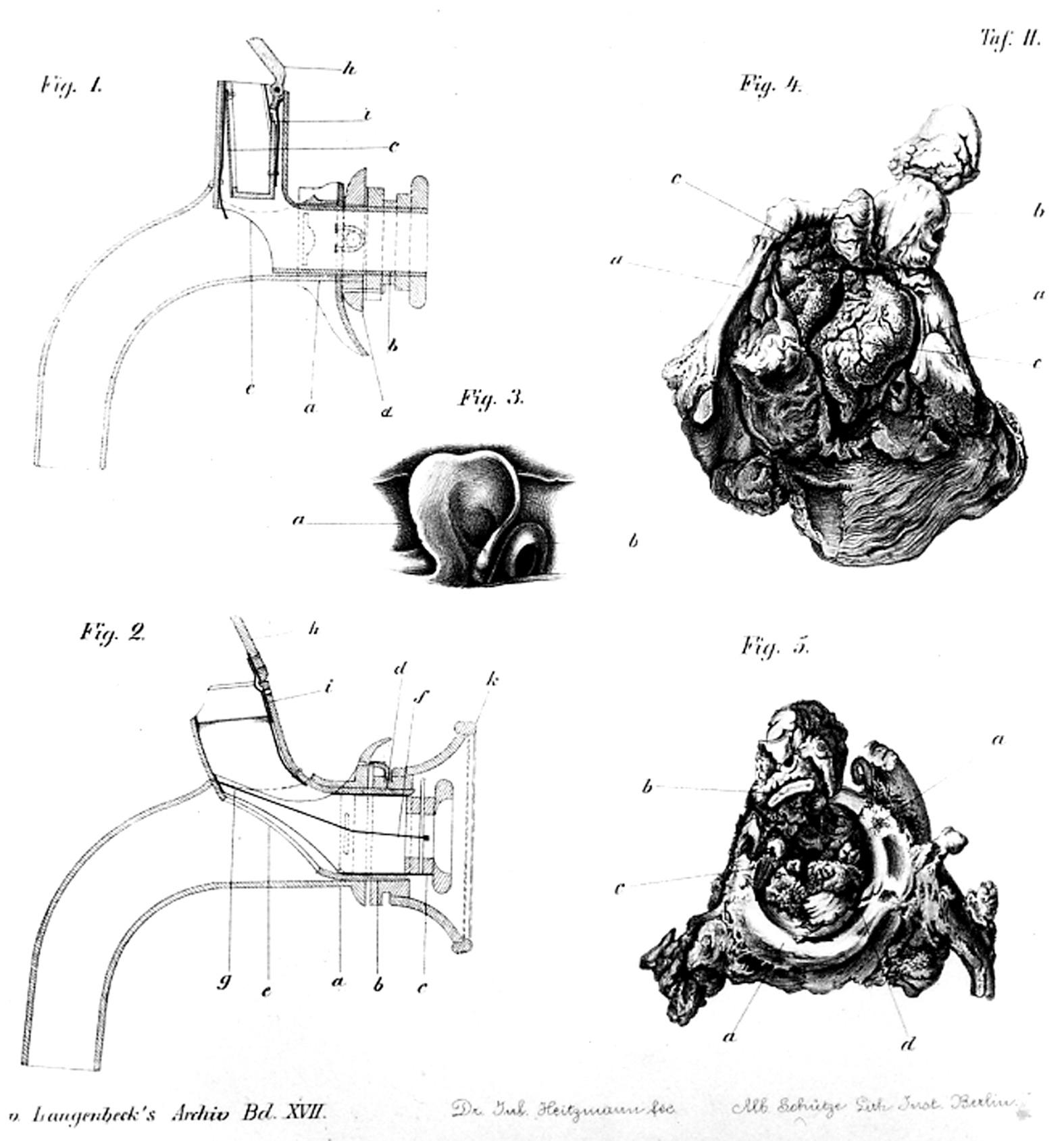 Fig. 111.1, Drawings from the original paper by Gussenbauer.