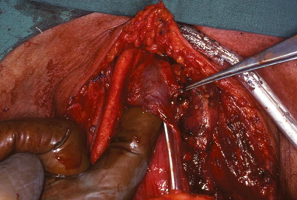 Fig. 111.11, Myotomy of the cricopharyngeal muscle to prevent hypertonicity of the pharyngoesophageal segment.