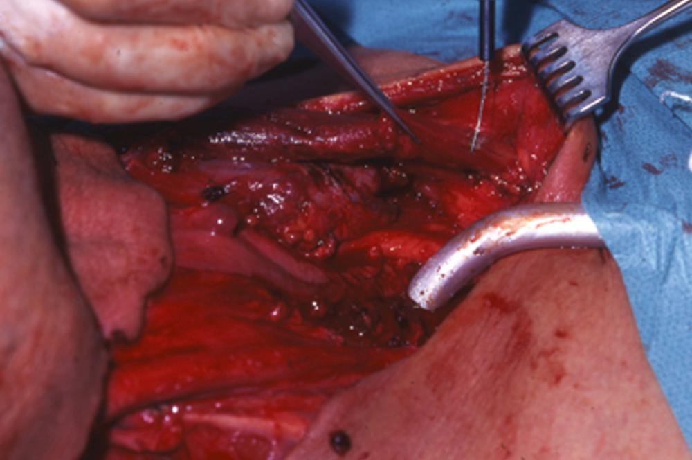 Fig. 111.13, Cutting of the sternal attachment of the sternocleidomastoid muscle on the left; the right side is already sectioned.