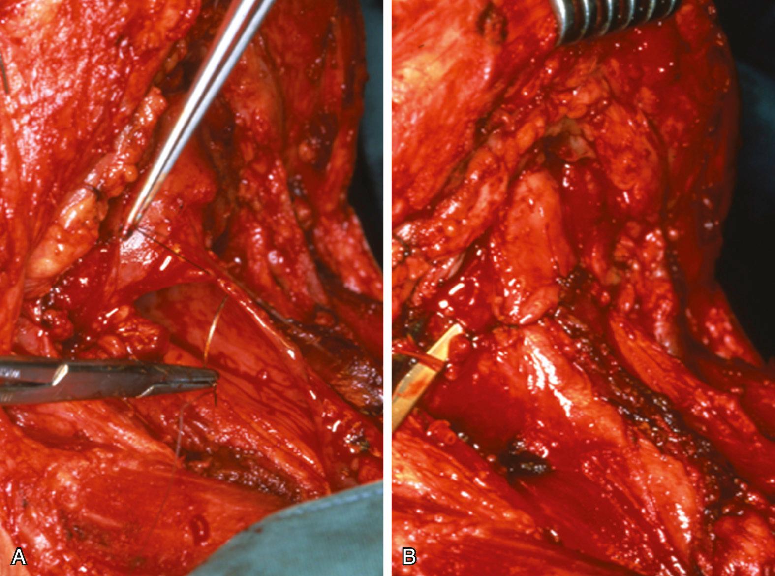 Fig. 111.14, Mucosa and constrictor pharyngeus muscle T -shaped closure to avoid pseudo-vallecula formation. (A) Closure of first (mucosa) layer. (B) Finished pharyngeal closure with constrictor muscles as the final layer and an instrument indicating an intact pharyngeal plexus branch (at left).