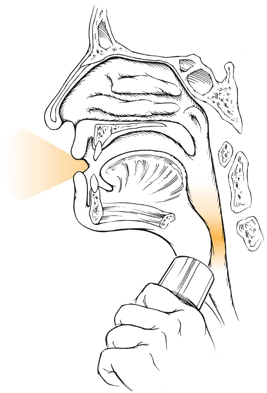 Fig. 111.5, Electrolarynx speech.