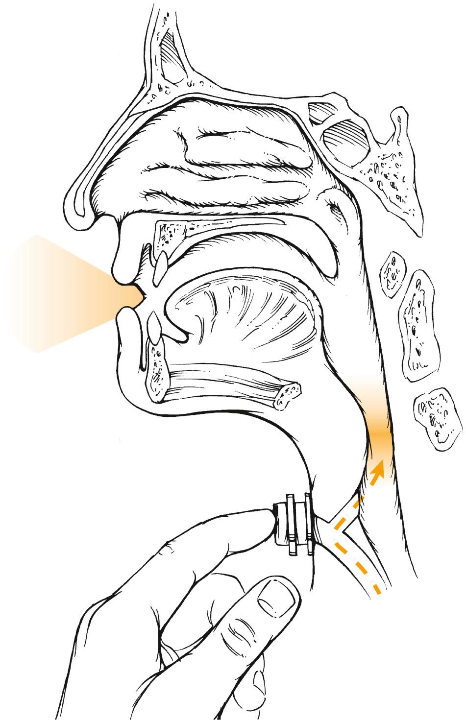 Fig. 111.6, Prosthetic voice rehabilitation. The dashed line indicates the pulmonary air; by occlusion of the stoma, air moving through the prosthesis is diverted into the pharyngoesophageal segment, where mucosal vibrations generate the sound for speech production in the vocal tract.