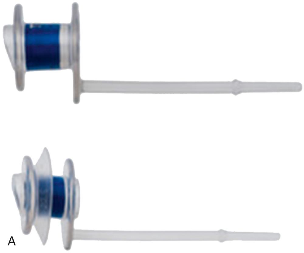 Fig. 111.9, The present standard indwelling Provox Vega VP is available in six shaft lengths (4, 6, 8, 10, 12.5, and 15 mm). Aside from the 22.5 Fr diameter preferred in Europe, there are also 20 and 17 Fr versions. Likewise, there are extended esophageal flange versions (Vega XtraSeal) for solving periprosthetic leakage. Both the Vega and the Vega XtraSeal (A) can be inserted with an automatic insertion device, giving optimal control over the procedure. However, the classic Provox2 insertion procedure can also be simulated by detaching the loading part of the device. Besides, the loading device also can be used to apply a gel cap for anterograde VP insertion. The three settings are shown below (B). See Videos 111.2 through 111.6 .