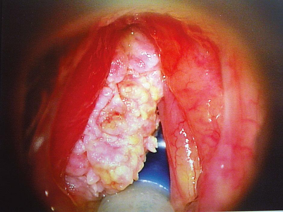 Figure 62, Laryngeal carcinoma .
