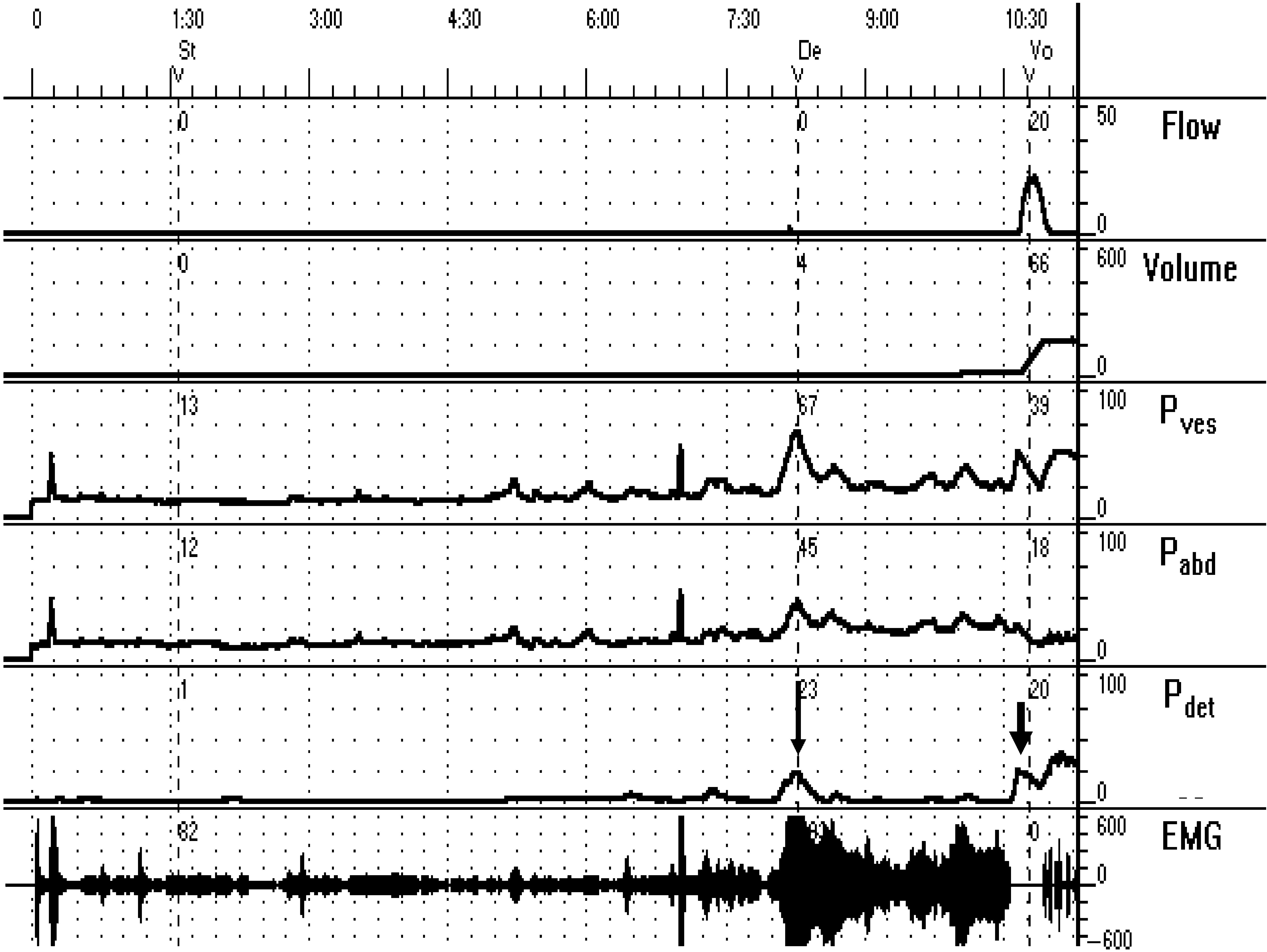 Fig. 34.2, Urodynamic representation of the micturition cycle. Note that during filling there is an involuntary detrusor contraction ( arrow ) accompanied by an increase in external sphincter activity, as portrayed by increased EMG activity (guarding reflex). The contraction abates, and then normal voiding ensues ( large arrow ). First there is relaxation of the external sphincter, followed by a voluntary detrusor contraction and initiation of flow. P ves , Intravesical pressure; P abd , intraabdominal pressure; P det , detrusor pressure; EMG , electromyography.