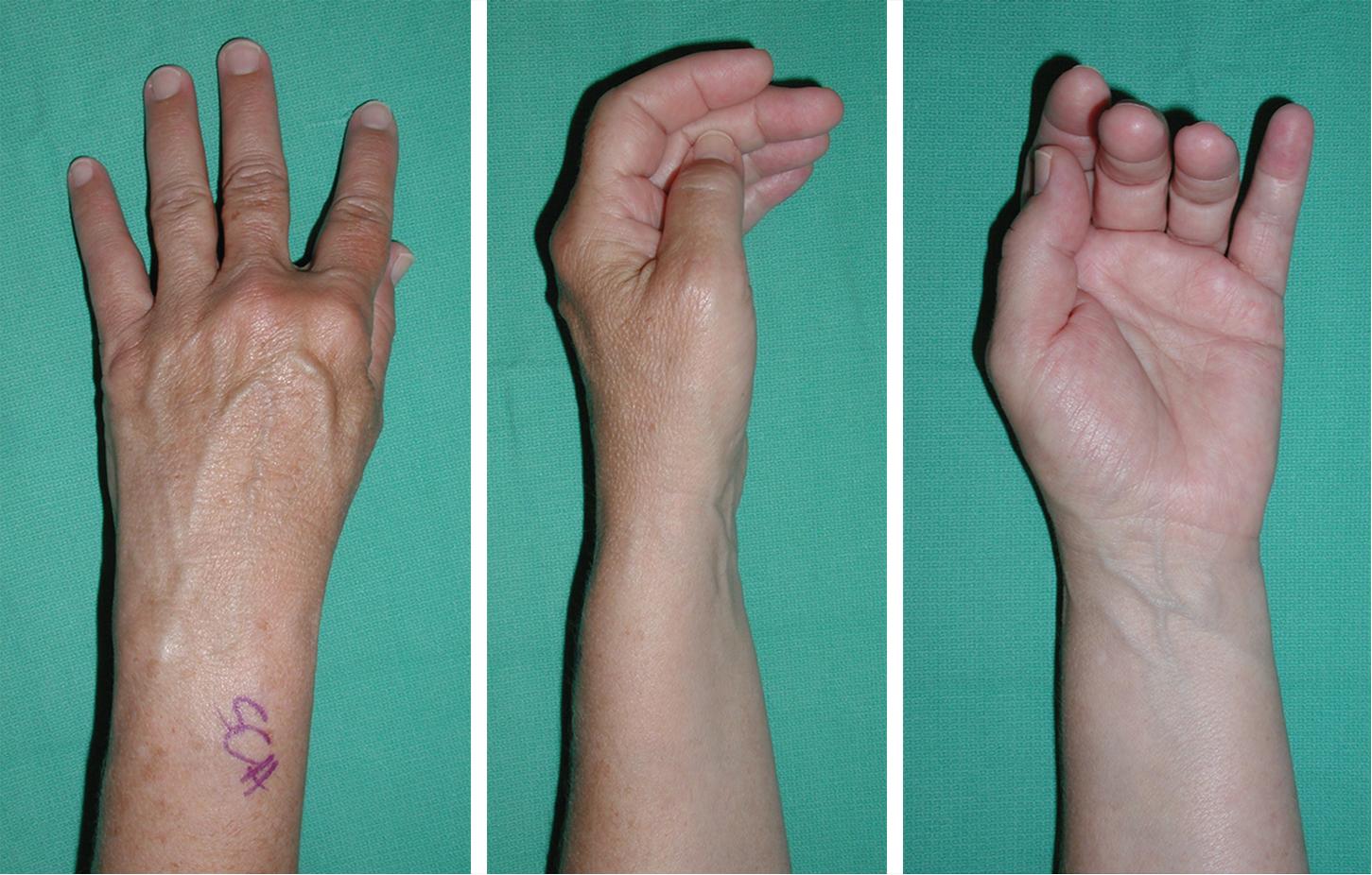 FIGURE 12.1, Small finger presents with pain and stiffness.