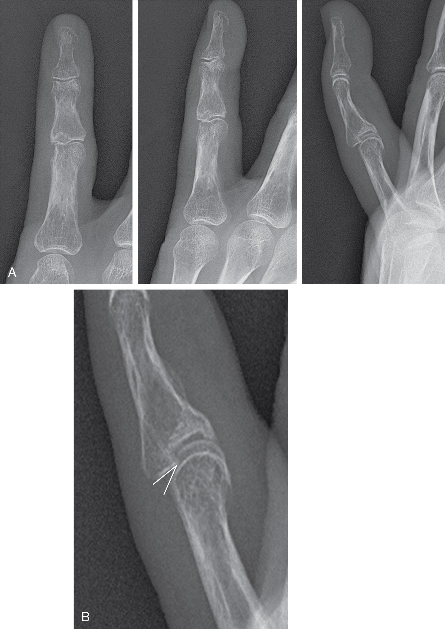 FIGURE 12.2, (A–B) Plain radiographs demonstrate subtle subluxation of the middle phalanx.