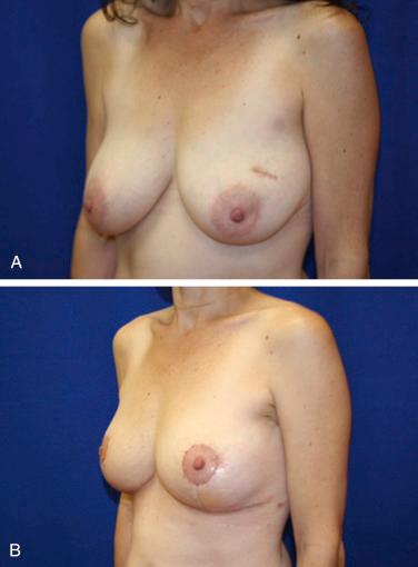Fig. 7.1, A 42-year-old with left breast cancer referred for partial mastectomy reconstruction. Due to concerns for positive margins, a staged-immediate reconstruction was performed. (A) Lumpectomy incision shown in upper outer quadrant. (B) Volume displacement technique with mastopexy approach and simultaneous symmetry procedure before radiation. Lumpectomy incision excised through Wise pattern approach.