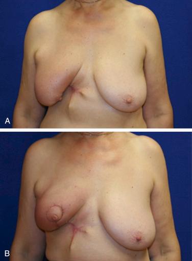 Fig. 7.2, A 47-year-old with right breast cancer referred for delayed oncoplastic reconstruction. She was never offered an immediate reconstruction. (A) Shown following partial mastectomy and radiation therapy without reconstruction. (B) Postoperative result following delayed reconstruction with volume displacement technique.