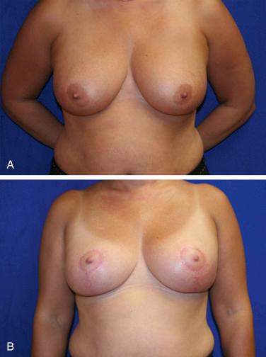 Fig. 7.3, A 42-year-old with right breast cancer referred for immediate oncoplastic reconstruction. (A) Preoperative views showing large, ptotic breasts. (B) Twelve months following immediate partial mastectomy reconstruction with reduction technique and symmetry procedure performed 3 months after radiation.