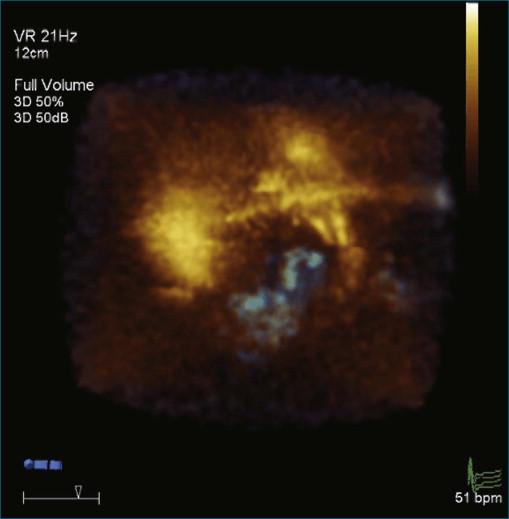 Figure 11-6, Example of normal left ventricular systolic function and wire frame over the cardiac cycle (see Video 11-6).