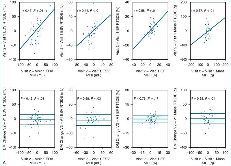 Figure 11-16, Sequential three-dimensional ( 3D ) echocardiographic measurements of changes in volume and ejection fraction ( EF ) are similar to those obtained using magnetic resonance imaging ( MRI ), but two-dimensional echocardiography ( 2DE ) overestimated change in end-diastolic volume ( EDV ). Changes over follow-up ( top ) and difference from mean ( DM ) change ( bottom ) with ( A ) real-time three-dimensional echocardiography ( RT3DE ) and MRI ( n = 50) and ( B ) 2DE and MRI ( n = 50). ESV , end-systolic volume; Mass , left ventricular mass. (From Jenkins C, Bricknell K, Chan J, Hanekom L, Marwick TH: Comparison of two- and three-dimensional echocardiography with sequential magnetic resonance imaging for evaluating left ventricular volume and ejection fraction over time in patients with healed myocardial infarction. Am J Cardiol 99[3]:300–306, 2007.)