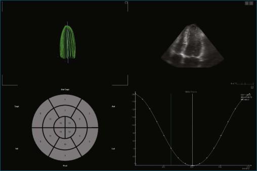 Figure 11-7, Example of endocardial border tracking of normal left ventricular systolic function and measurement of volumes (see Video 11-7).