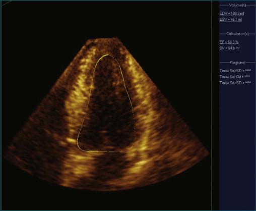 Figure 11-8, Example of poor left ventricular systolic function and the 16-segment model (see Video 11-8).