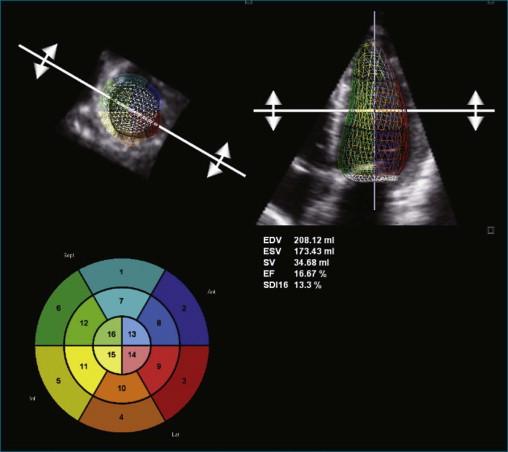 Figure 11-9, Example of poor left ventricular systolic function and a time volume curve (see Video 11-9).