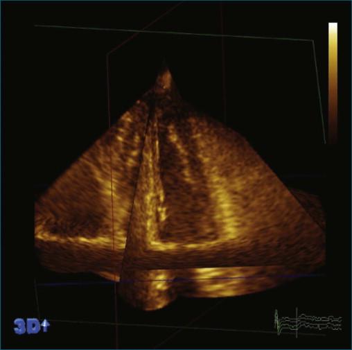 Figure 11-11, Example of a stitching artifact, one of the limitations of acquiring over four cardiac cycles (see Video 11-11).