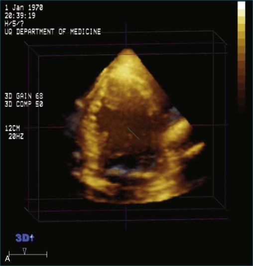 Figure 11-12, A, Example of poor three-dimensional imaging. B, The same patient with the use of contrast left ventricular opacification (see Videos 11-12 and 11-13).