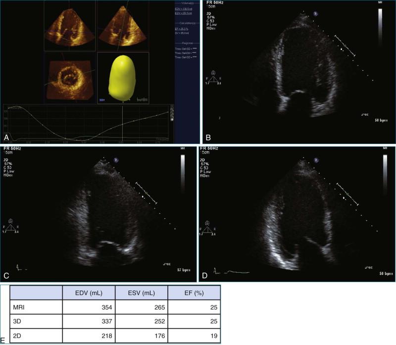 Figure 11-13, Patient with poor global left ventricular function. A, Three-dimensional ( 3D ) left ventricular volume and ejection fraction ( EF ) measurement. B, Two-dimensional ( 2D ) apical four-chamber view. C, 2D apical two-chamber view. D, 2D apical long-axis view. E, Table of measures, comparison of magnetic resonance imaging ( MRI ), 3D, and 2D results (see Videos 11-14 to 11-17). EDV, end-diastolic volume; ESV, end-systolic volume.