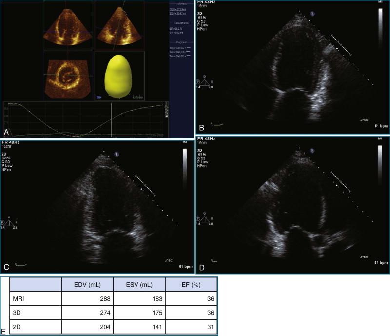 Figure 11-14, Patient with poor left ventricular function with regional wall motion abnormalities. A, Three-dimensional ( 3D ) left ventricular volume and ejection fraction ( EF ) measurement. B, Two-dimensional ( 2D ) apical four-chamber view. C, 2D apical two-chamber view. D, 2D apical long-axis view. E, Table of measures, comparison of magnetic resonance imaging ( MRI ), 3D, and 2D results (see Videos 11-18 to 11-20). EDV, end-diastolic volume; ESV, end-systolic volume.