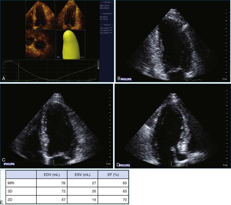 Figure 11-15, Patient with normal left ventricular function. A, Three-dimensional ( 3D ) left ventricular volume and ejection fraction ( EF ) measurement. B, Two-dimensional ( 2D ) apical four-chamber view. C, 2D apical two-chamber view. D, 2D apical long-axis view. E, Table of measures, comparison of magnetic resonance imaging ( MRI ), 3D, and 2D results (see Videos 11-22 to 11-25). EDV, end-diastolic volume; ESV, end-systolic volume.