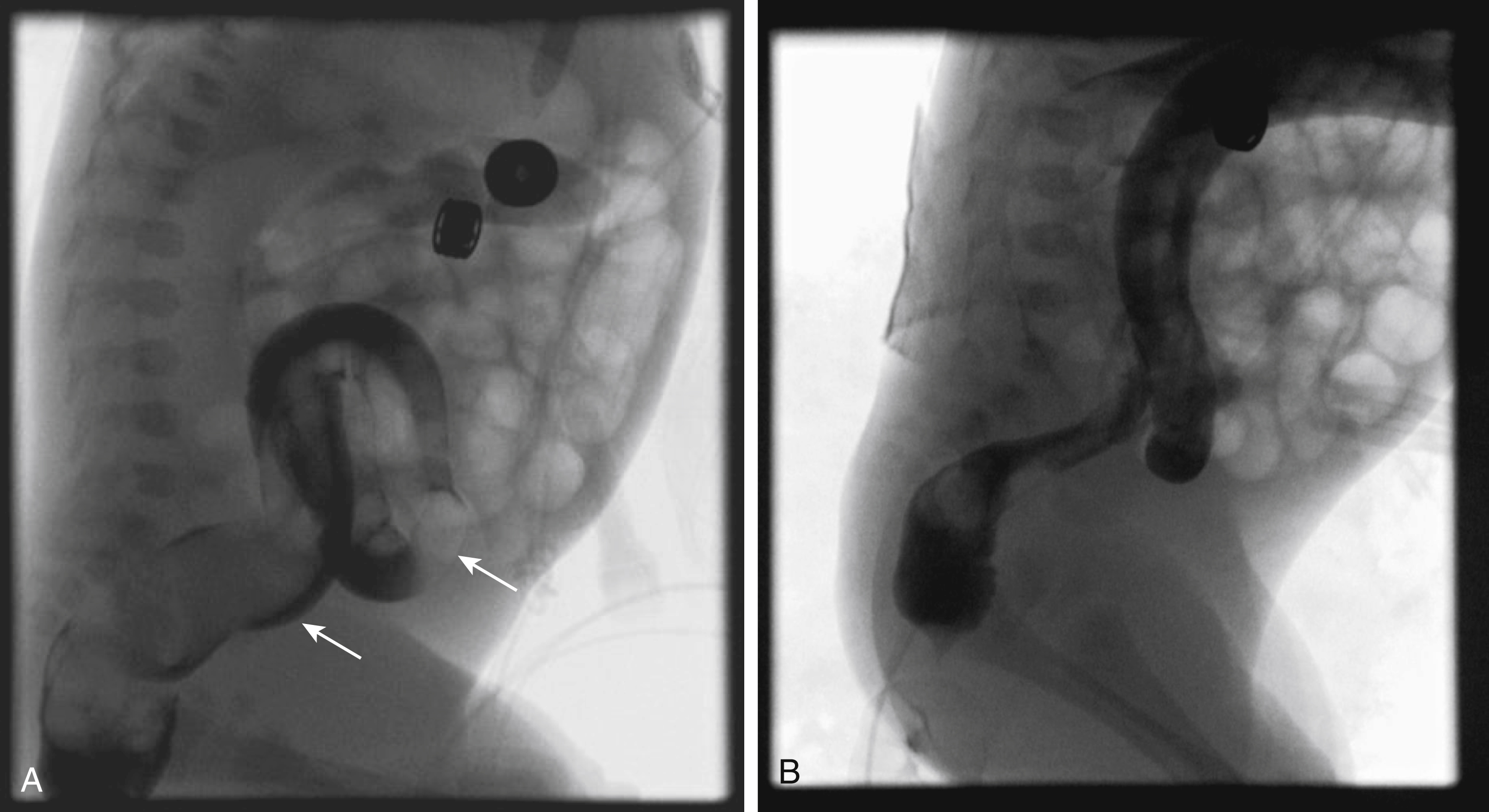 Fig. 4.13, Functional immaturity of the colon.