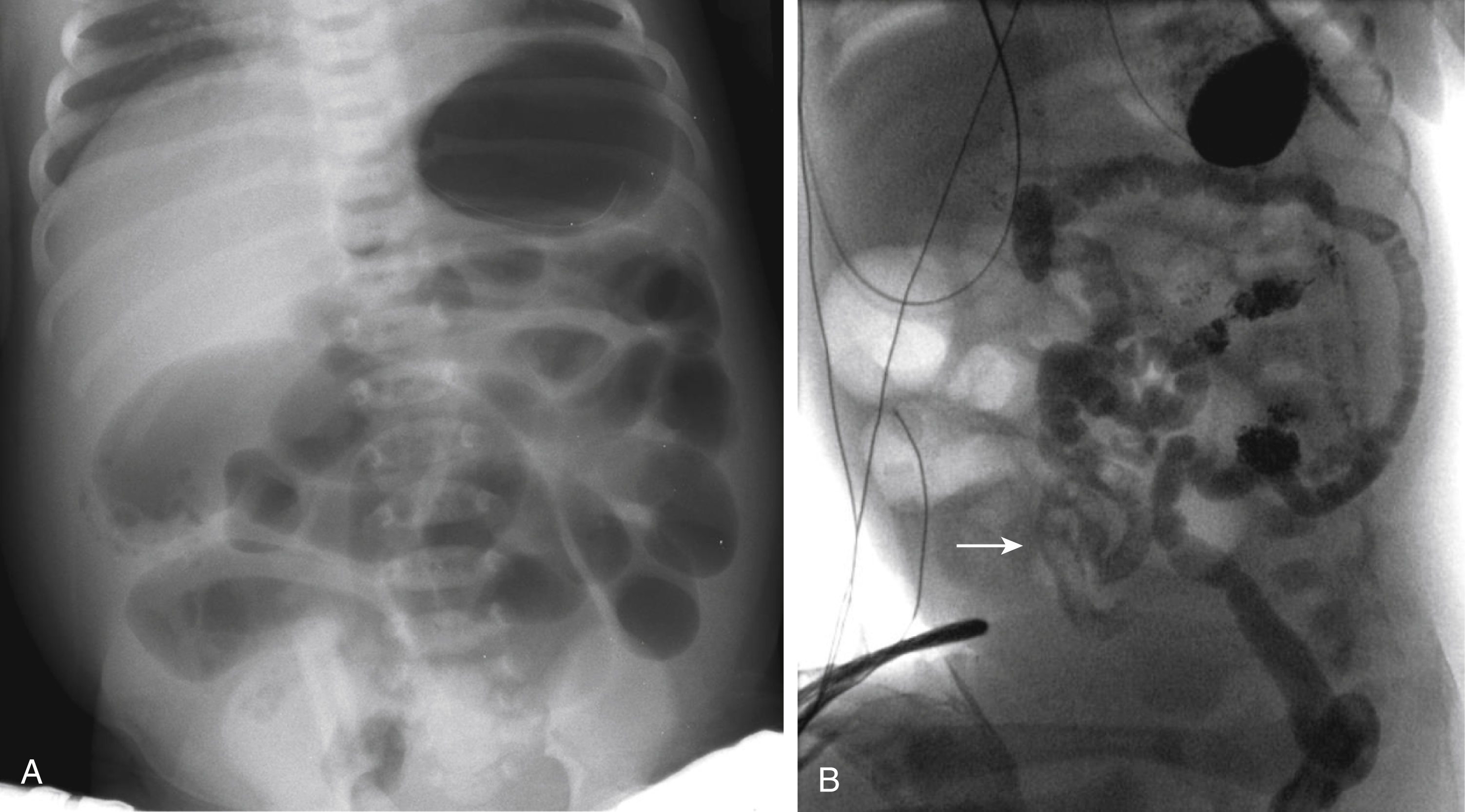 Fig. 4.14, Meconium ileus.