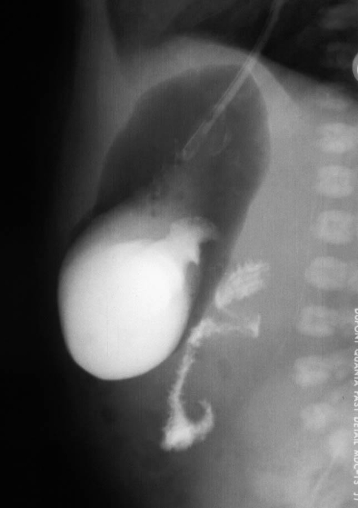 Fig. 4.3, Malrotation with midgut volvulus.