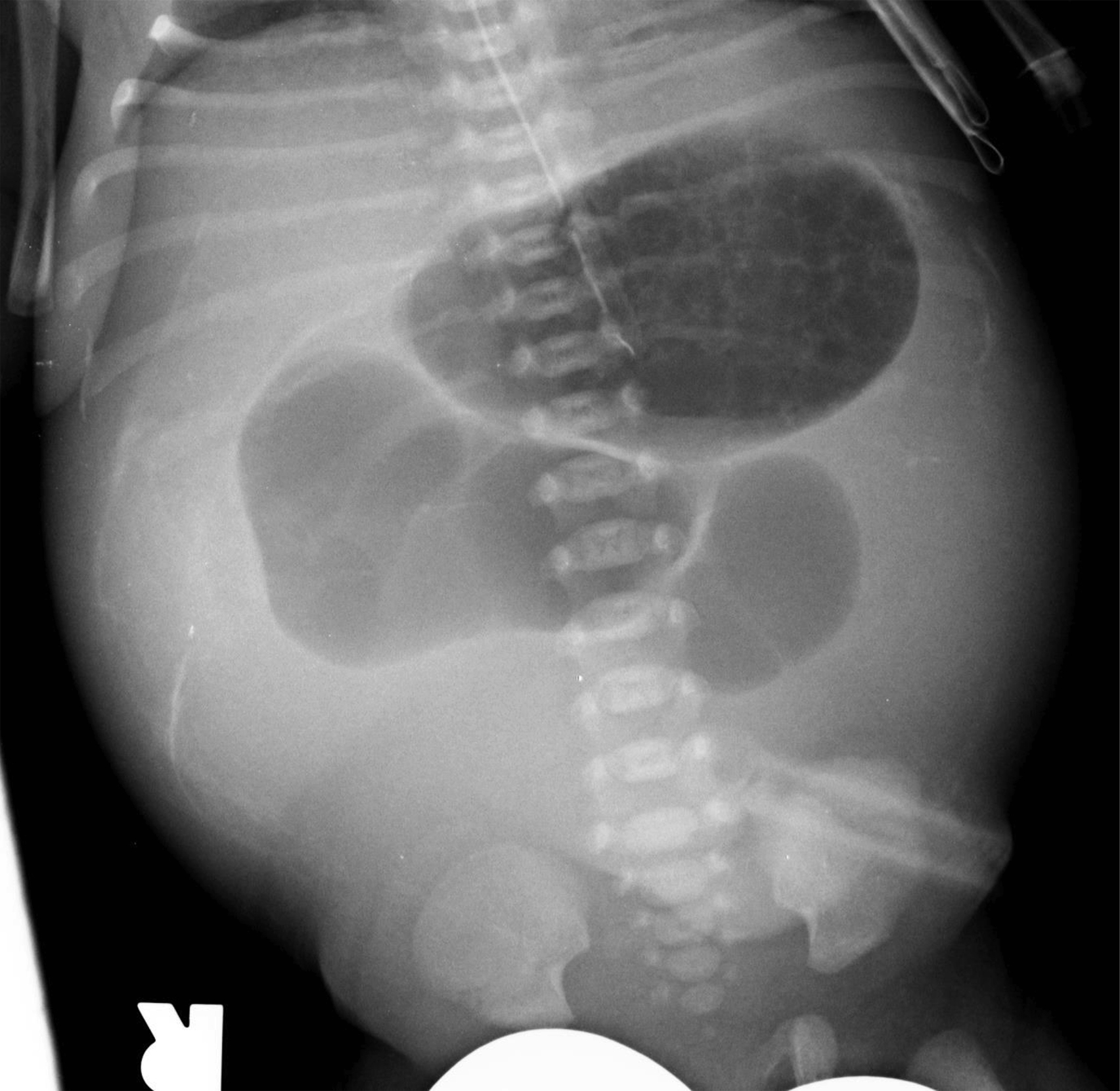Fig. 4.10, Jejunal atresia.
