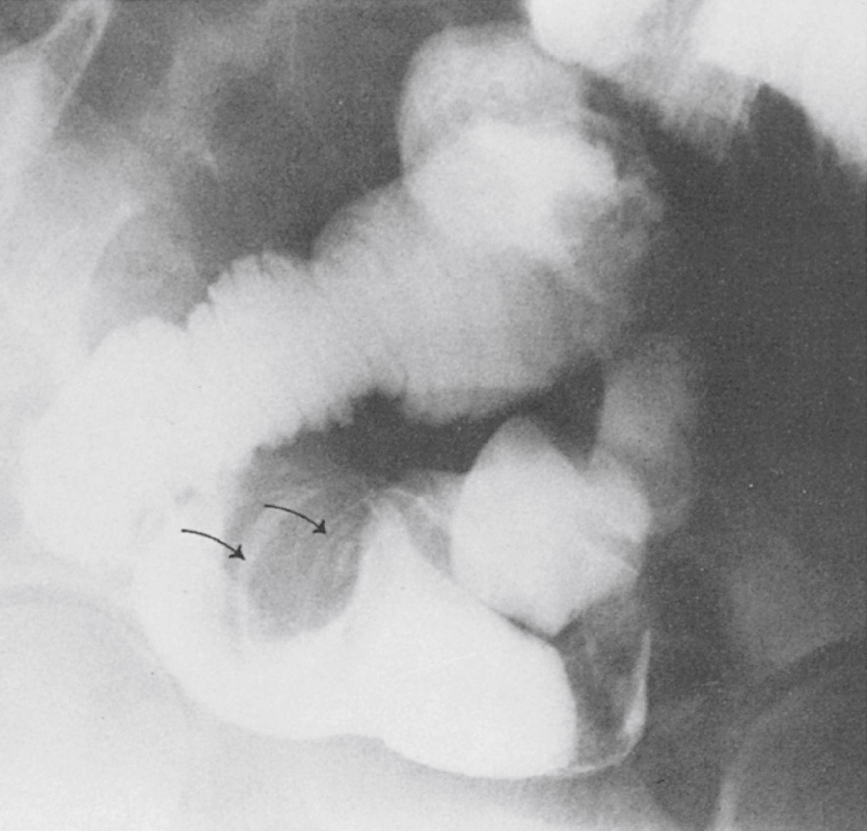 Fig. 15.11, Enteroenteric intussusception (arrows) .